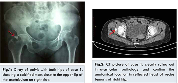 acute-rectus-femoris-calcific-tendinitis
